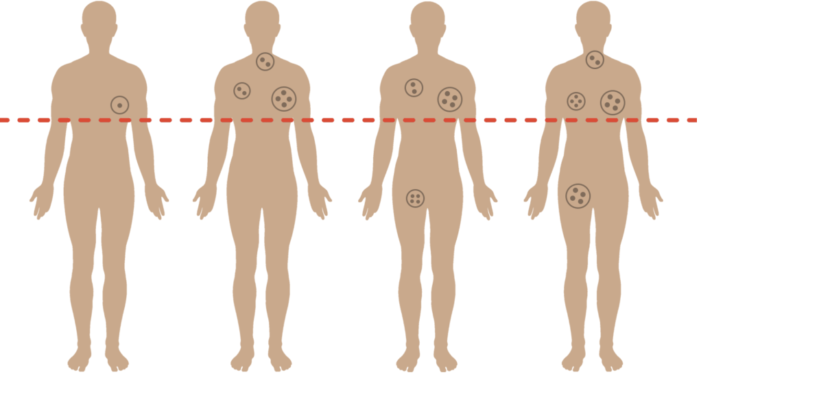 Hodgkin Lymphoma Above and Below the Diaphragm: Are The Outcomes Different?